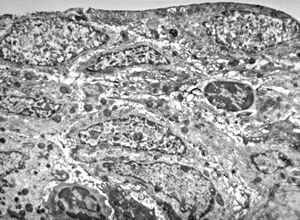 M,18y. | immotile cilia syndrome - bronchus M,18y. | immotile cilia syndrome - bronchus